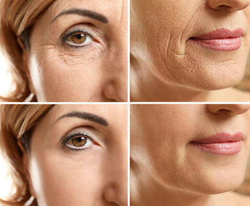 Mesotherapie Needling